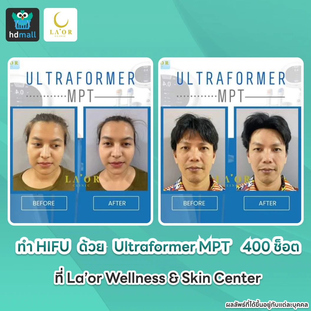 ทำ HIFU ด้วยเครื่อง Ultraformer MPT 400 ช็อต ยกกระชับบริเวณทั่วใบหน้าและเหนียง 1 ครั้ง