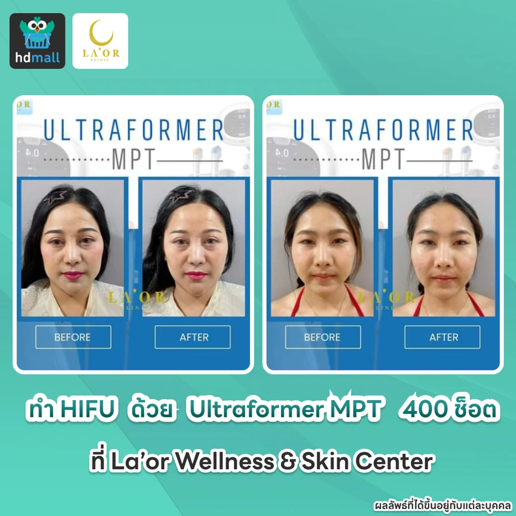 ทำ HIFU ด้วยเครื่อง Ultraformer MPT 400 ช็อต ยกกระชับบริเวณทั่วใบหน้าและเหนียง 1 ครั้ง