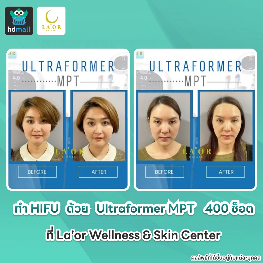 ทำ HIFU ด้วยเครื่อง Ultraformer MPT 400 ช็อต ยกกระชับบริเวณทั่วใบหน้าและเหนียง 1 ครั้ง