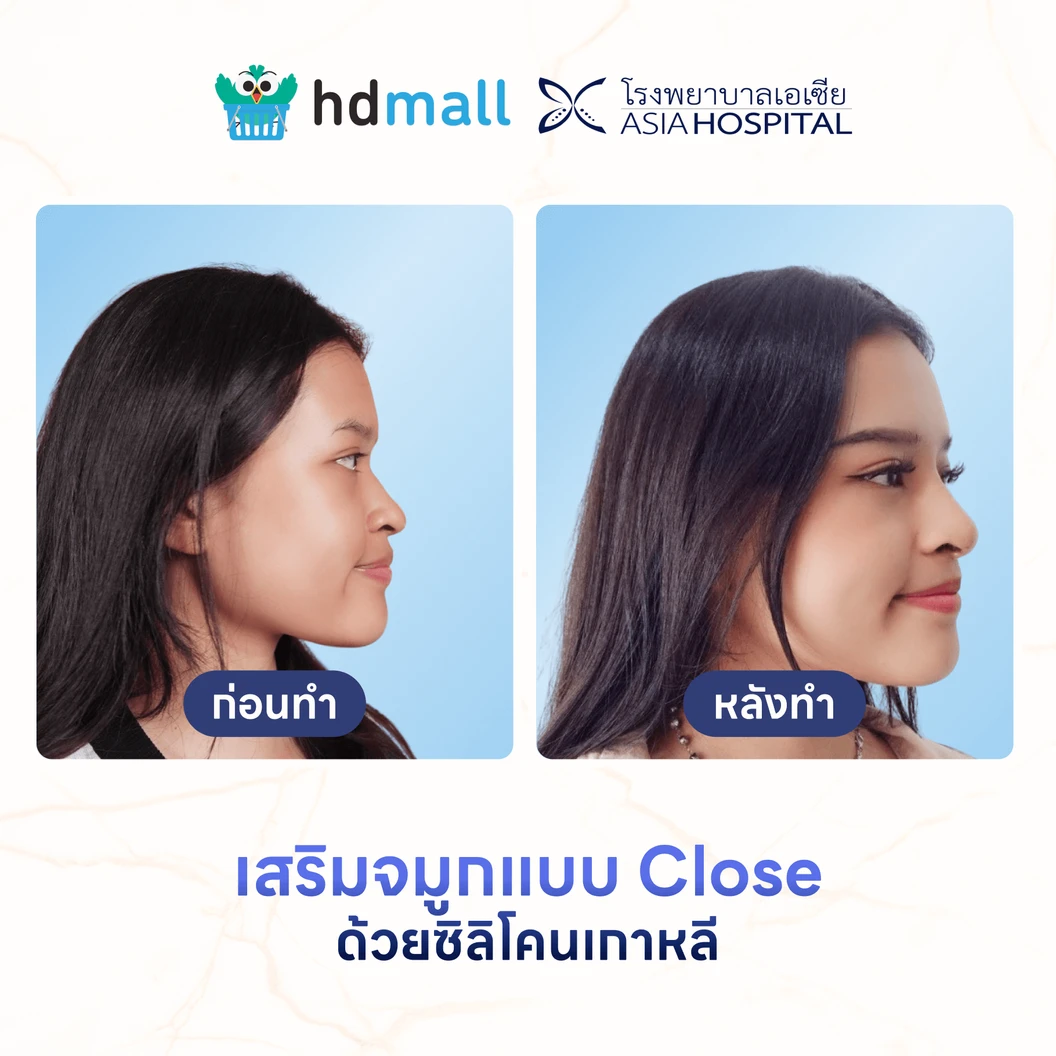 เสริมจมูกด้วยซิลิโคนเกาหลี เทคนิคแบบ Close สำหรับเคสเสริมครั้งแรก ที่ โรงพยาบาลเอเซีย