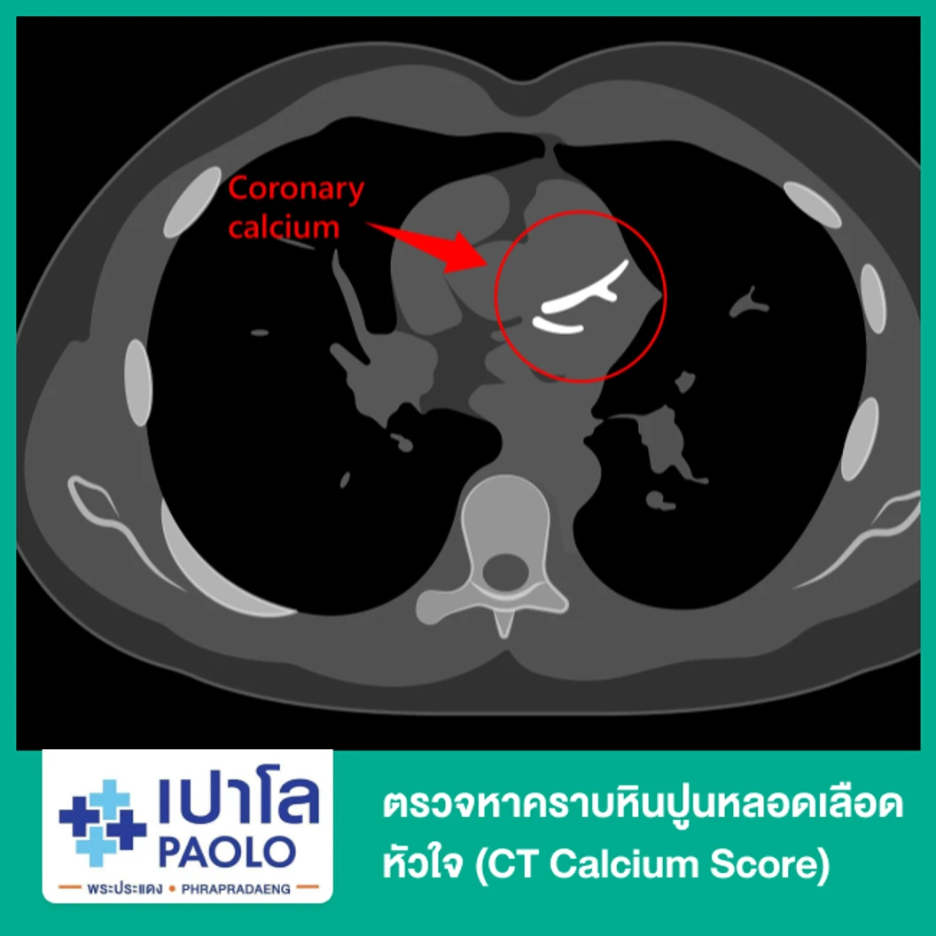 ตรวจหาคราบหินปูนหลอดเลือดหัวใจ (CT Calcium Score)