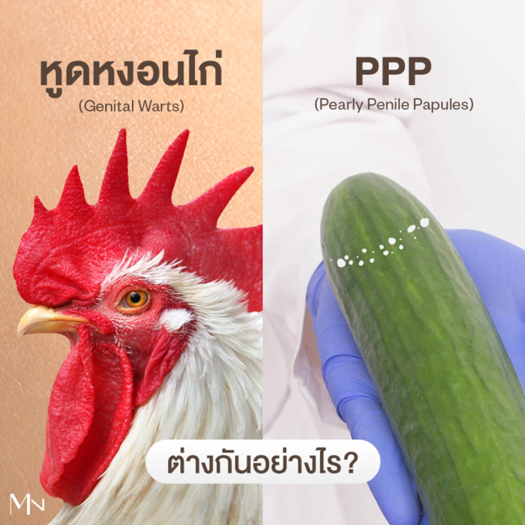 ผ่าตัดเพื่อเอาผื่นนูนที่อวัยวะเพศออก PPP (Pearly Penile Papules)