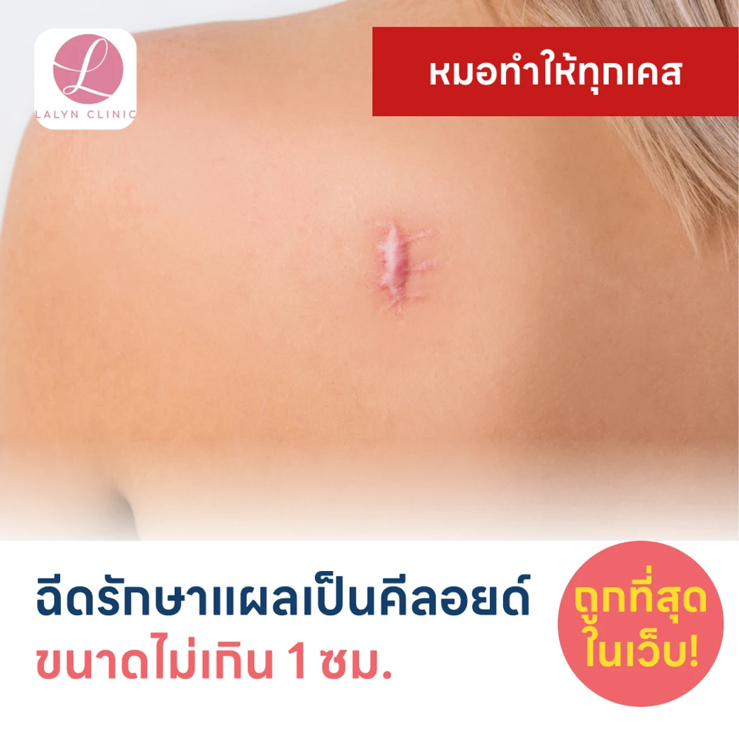 ฉีดรักษาแผลเป็นคีลอยด์ ขนาดเส้นผ่านศูนย์กลางไม่เกิน 1 ซม. 1 จุด 1 ครั้ง
