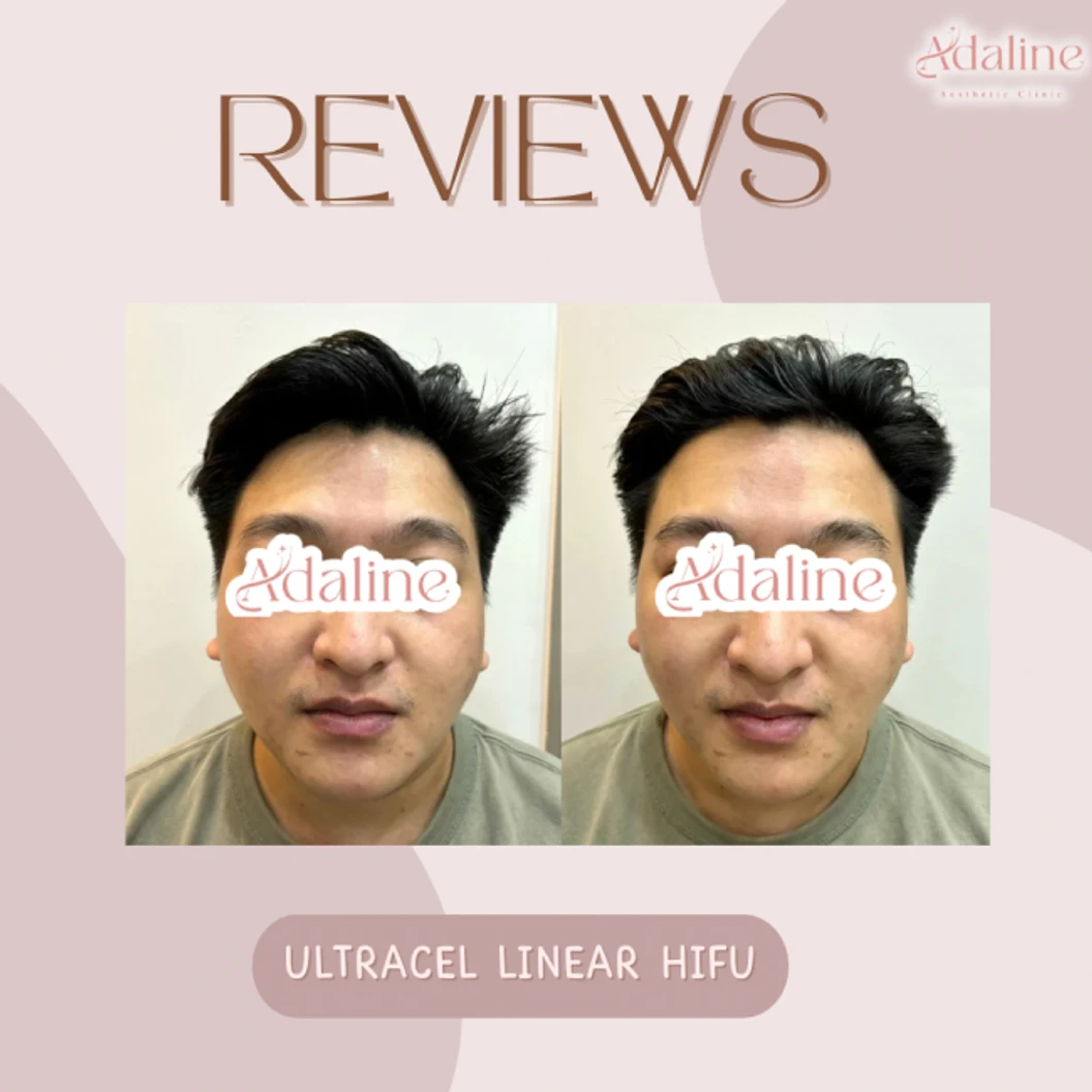 ทำ HIFU ด้วยเครื่อง Ultracel 400 ช็อต เพื่อยกกระชับและสลายไขมันบริเวณใบหน้า 1 ครั้ง