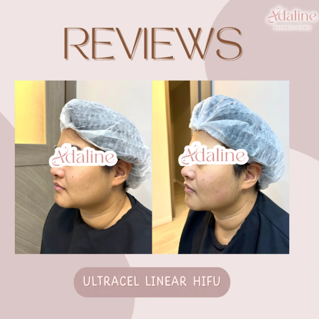 ทำ HIFU ด้วยเครื่อง Ultracel 600 ช็อต เพื่อยกกระชับและสลายไขมันบริเวณใบหน้า 1 ครั้ง