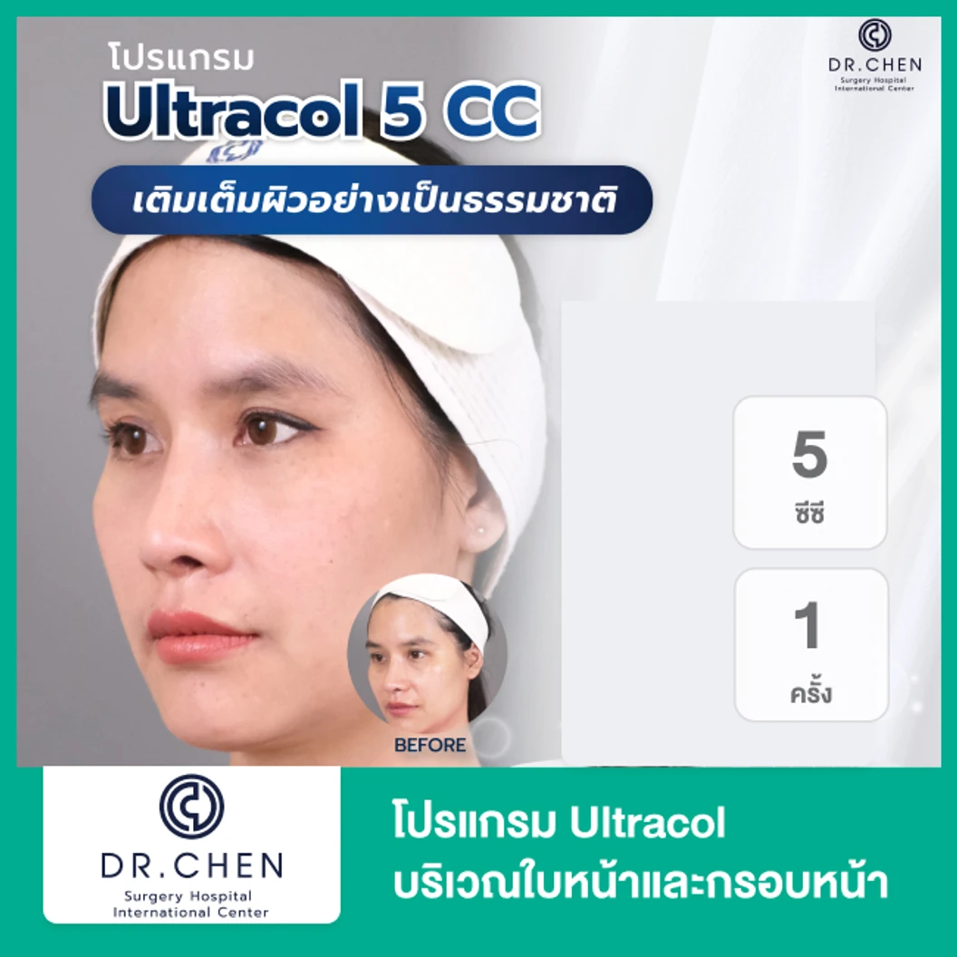 โปรแกรม Ultracol 5 ซีซี บริเวณใบหน้าและกรอบหน้า 1 ครั้ง