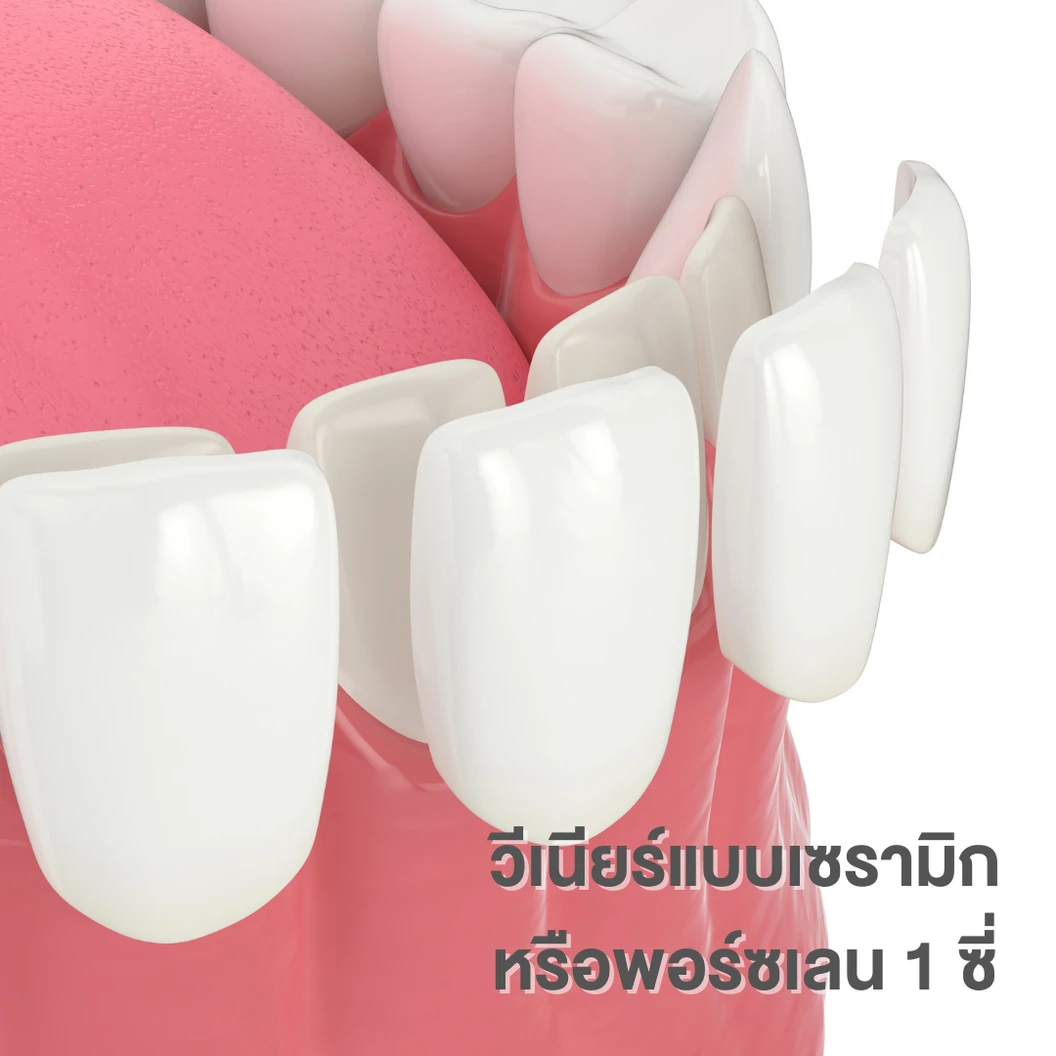 ทำวีเนียร์แบบเซรามิกหรือพอร์ซเลน 1 ซี่