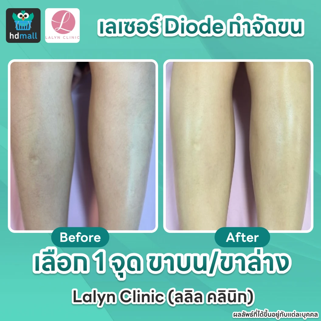 เลเซอร์ Diode กำจัดขน (เลือก 1 จุด ขาบน/ขาล่าง)