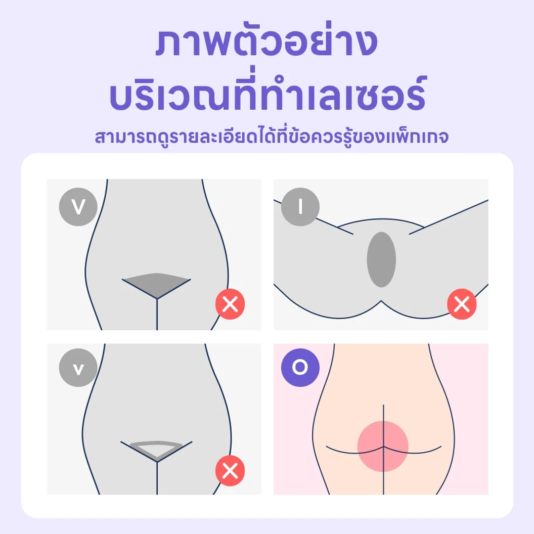 กำจัดขนแก้มก้น ด้วยเลเซอร์ 4 พลังงาน 1 ครั้ง ฟรี! 1 ครั้ง สำหรับผู้หญิงหรือผู้ชาย