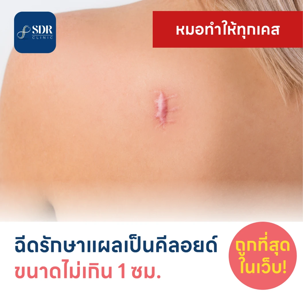 ฉีดรักษาแผลเป็นคีลอยด์ ขนาดเส้นผ่านศูนย์กลางไม่เกิน 1 ซม. 1 จุด 1 ครั้ง