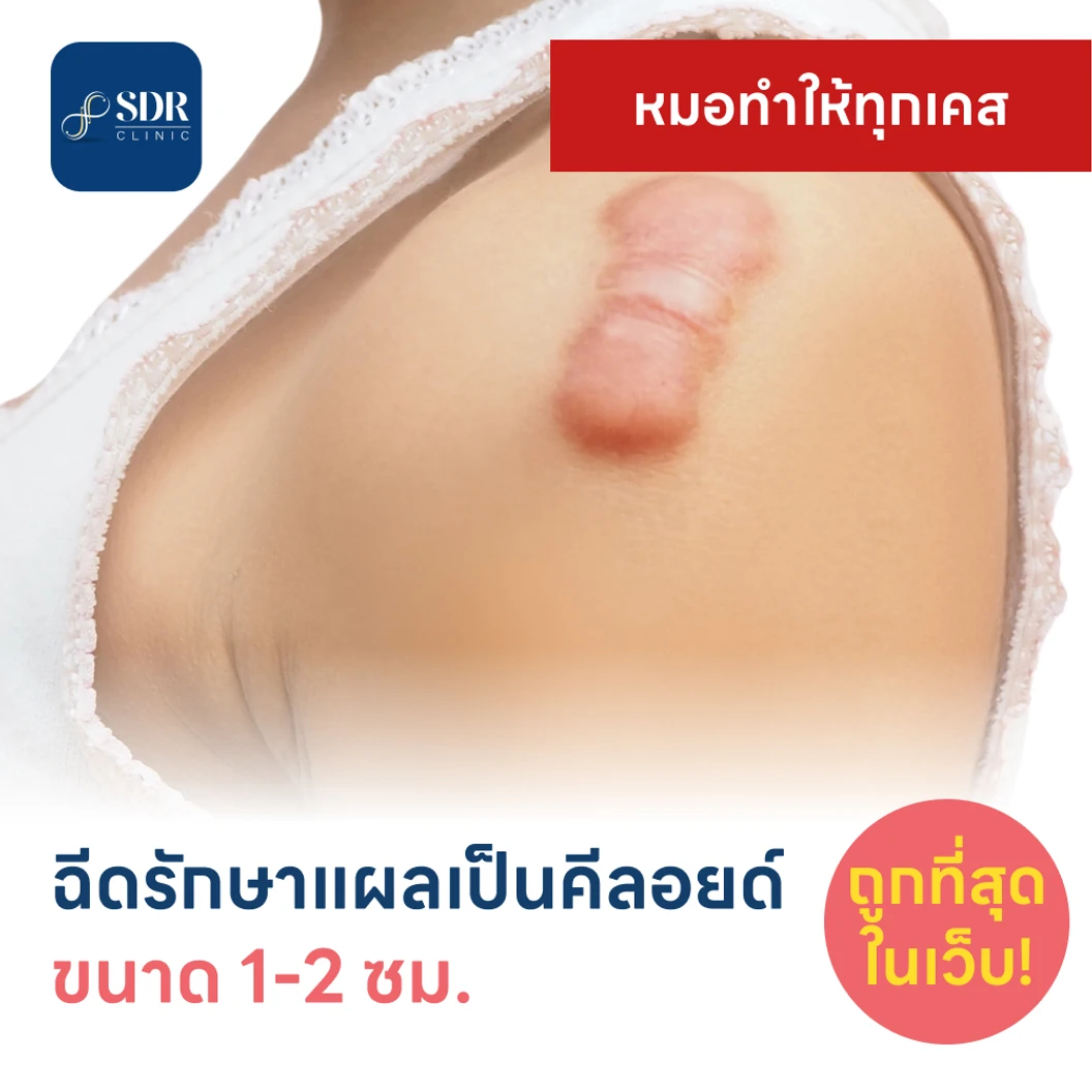 ฉีดรักษาแผลเป็นคีลอยด์ ขนาดเส้นผ่านศูนย์กลาง 1-2 ซม. 1 จุด 1 ครั้ง