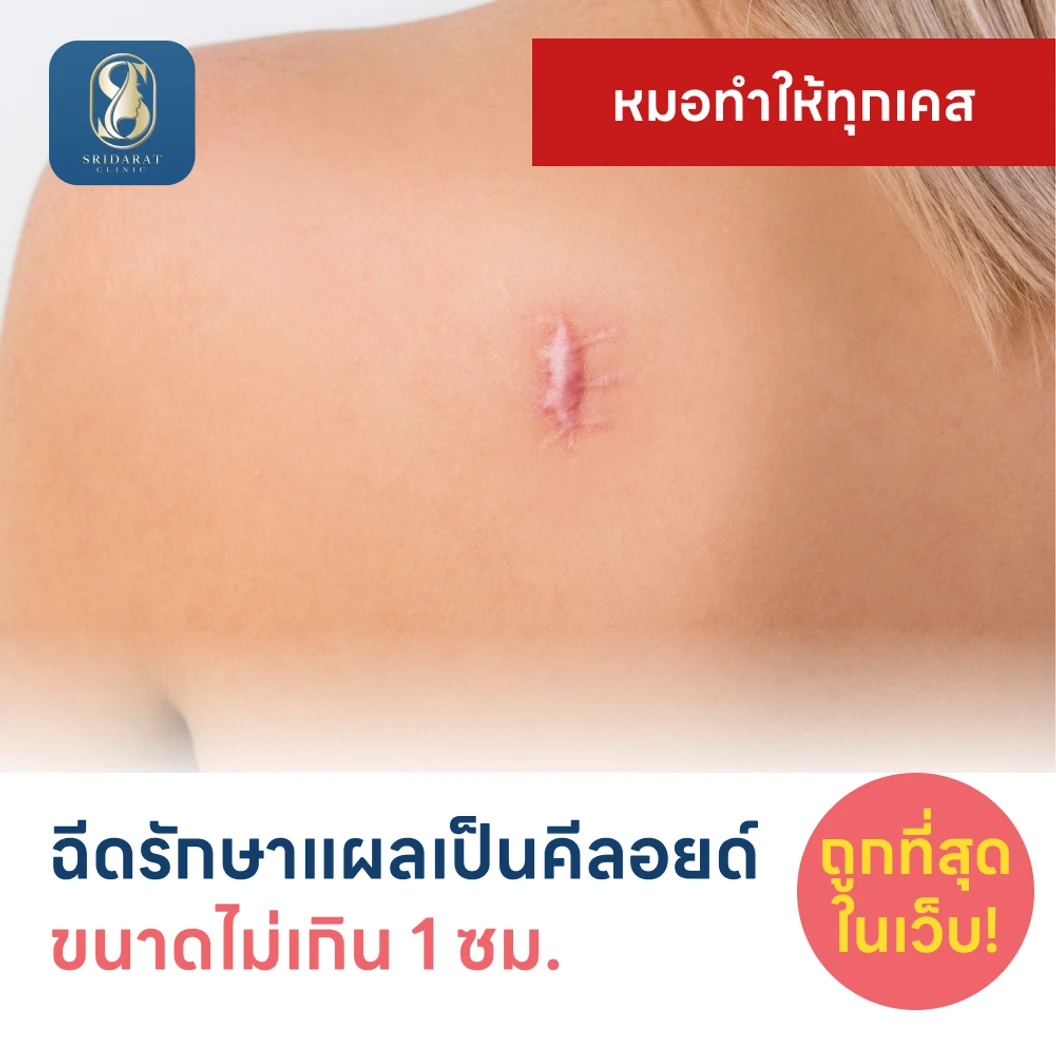 ฉีดรักษาแผลเป็นคีลอยด์ ขนาดเส้นผ่านศูนย์กลางไม่เกิน 1 ซม. 1 จุด 1 ครั้ง