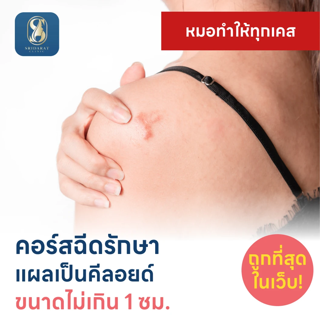 คอร์สฉีดรักษาแผลเป็นคีลอยด์ ขนาดเส้นผ่านศูนย์กลางไม่เกิน 1 ซม. 1 จุด 5 ครั้ง