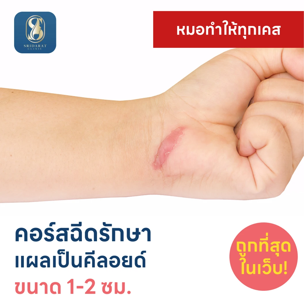 คอร์สฉีดรักษาแผลเป็นคีลอยด์ ขนาดเส้นผ่านศูนย์กลาง 1-2 ซม. 1 จุด 5 ครั้ง