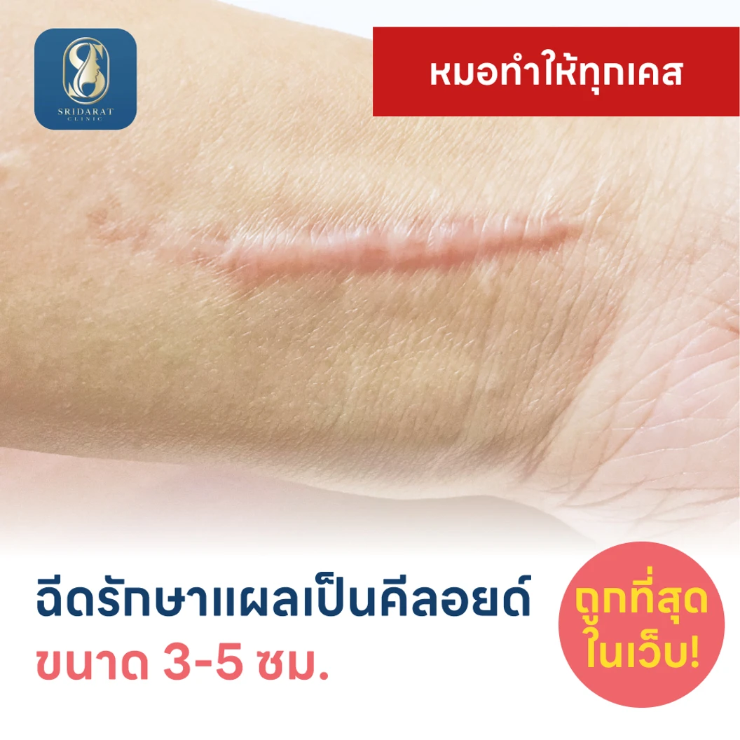 ฉีดรักษาแผลเป็นคีลอยด์ ขนาดเส้นผ่านศูนย์กลาง 3-5 ซม. 1 จุด 1 ครั้ง