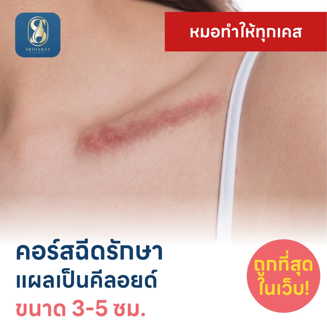 คอร์สฉีดรักษาแผลเป็นคีลอยด์ ขนาดเส้นผ่านศูนย์กลาง 3-5 ซม. 1 จุด 5 ครั้ง