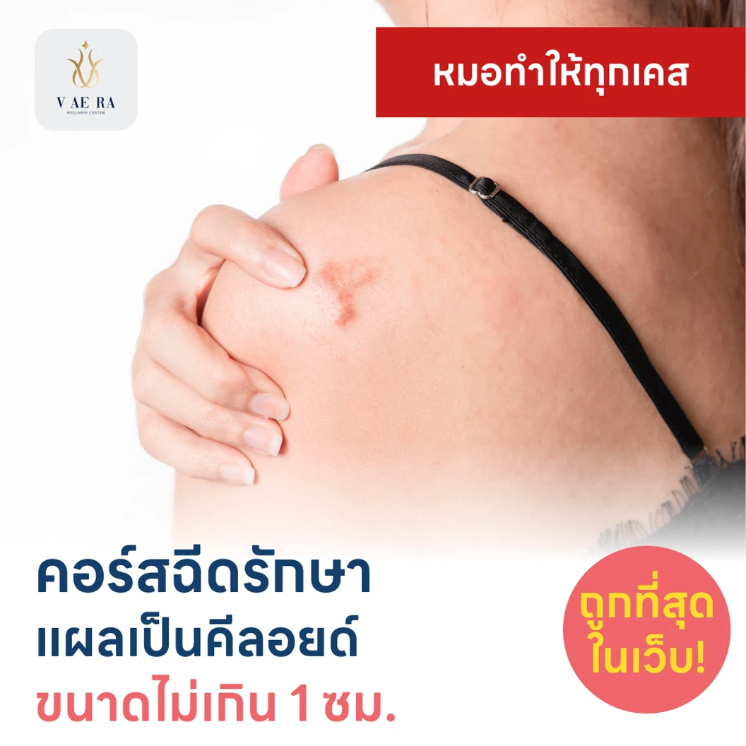คอร์สฉีดรักษาแผลเป็นคีลอยด์ ขนาดเส้นผ่านศูนย์กลางไม่เกิน 1 ซม. 1 จุด 5 ครั้ง