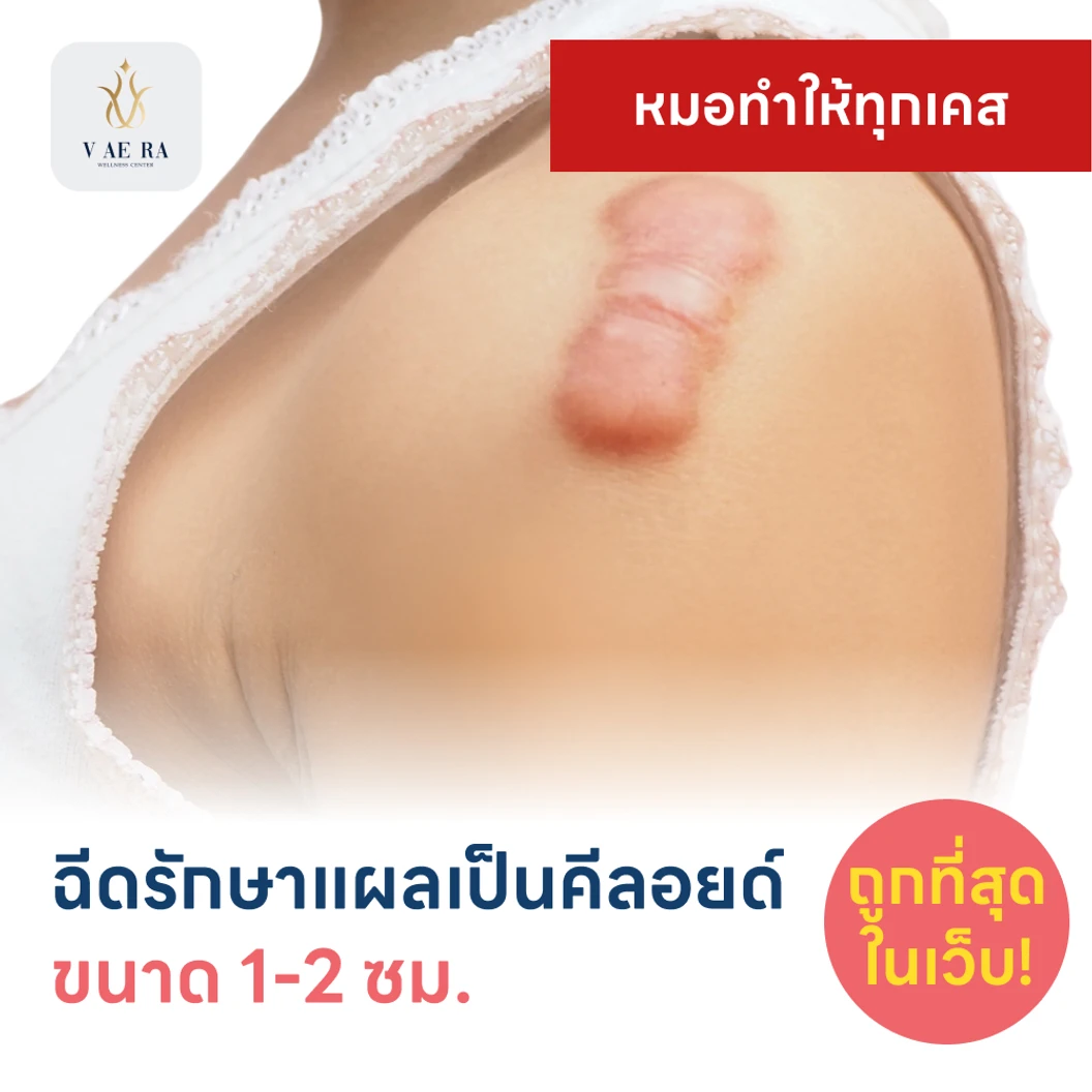 ฉีดรักษาแผลเป็นคีลอยด์ ขนาดเส้นผ่านศูนย์กลาง 1-2 ซม. 1 จุด 1 ครั้ง