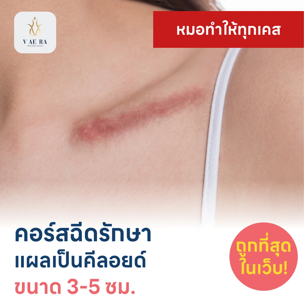 คอร์สฉีดรักษาแผลเป็นคีลอยด์ ขนาดเส้นผ่านศูนย์กลาง 3-5 ซม. 1 จุด 5 ครั้ง