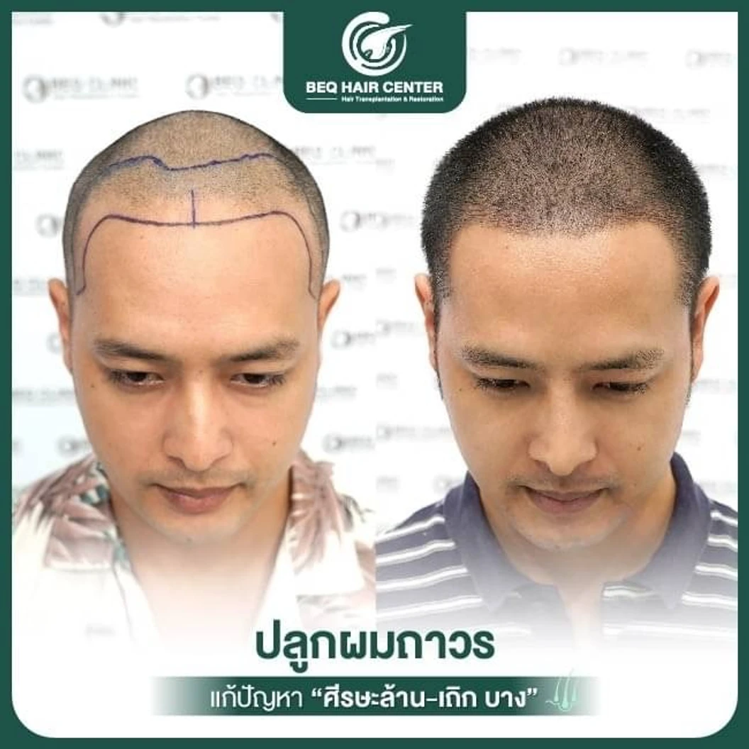 ปลูกผมเทคนิค iFUE แบบโกนผม สูงสุด 1,000 กราฟต์