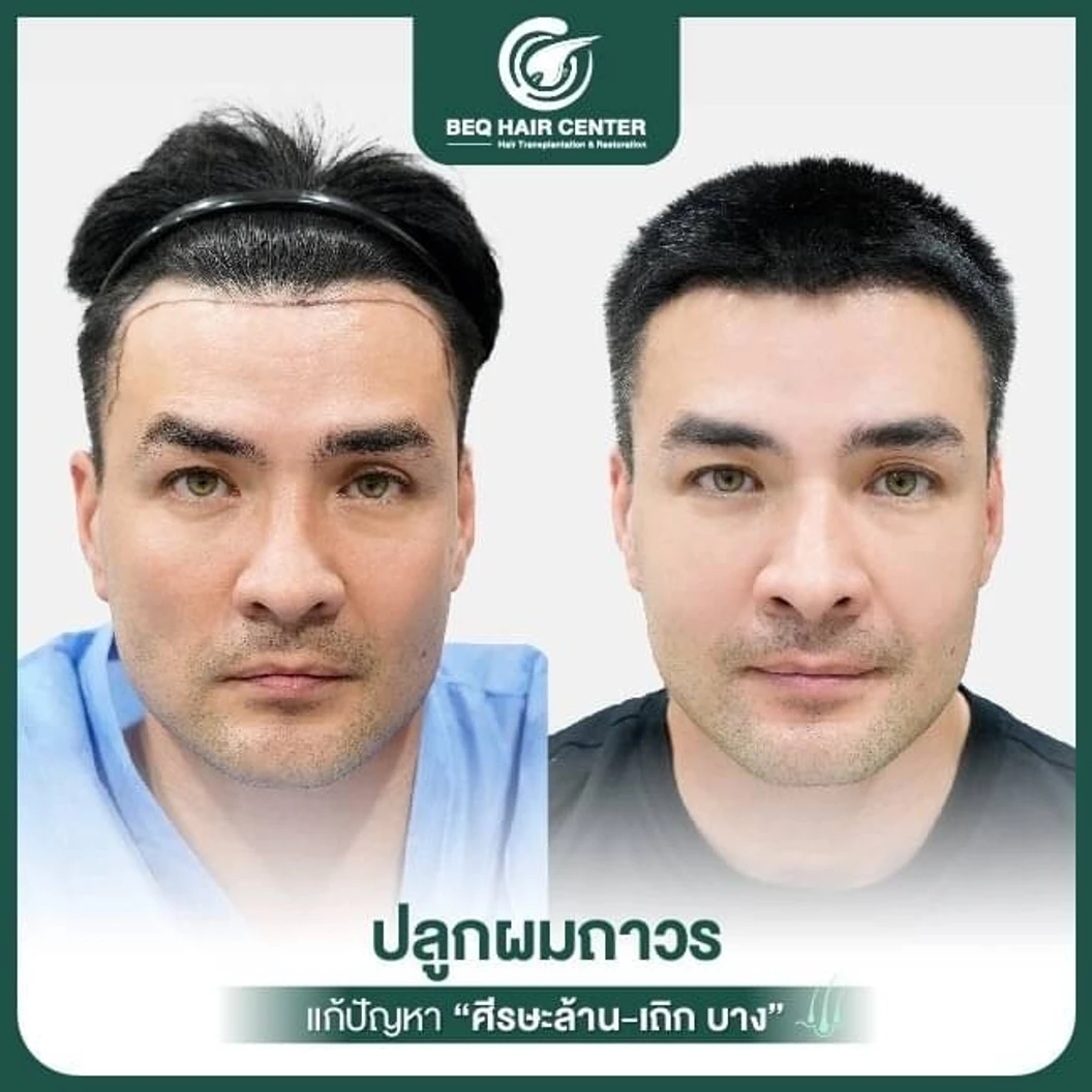 ปลูกผมเทคนิค iFUE แบบโกนผม สูงสุด 1,000 กราฟต์