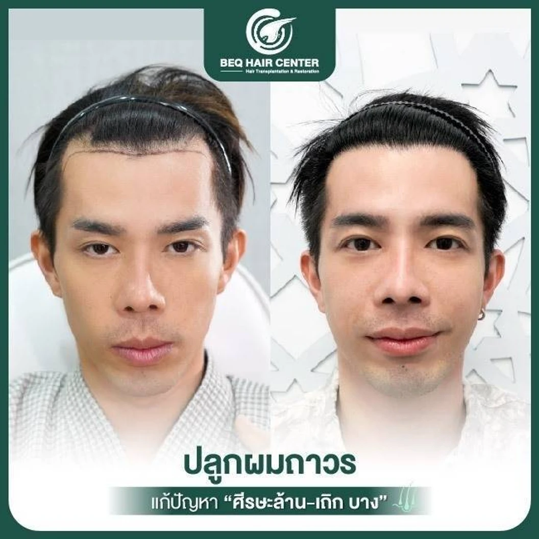 ปลูกผมเทคนิค iDHI แบบโกนผม สูงสุด 1,000 กราฟต์