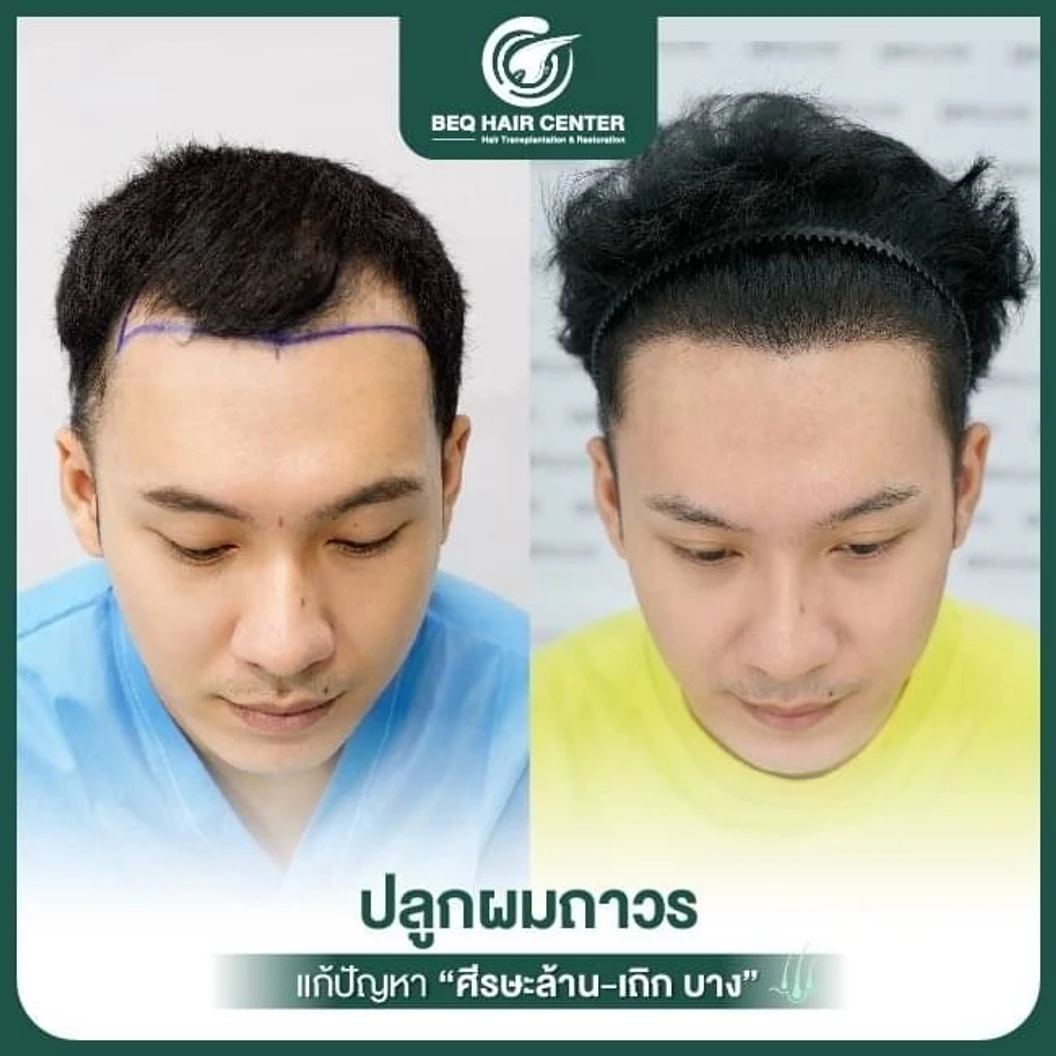 ปลูกผมเทคนิค iDHI แบบโกนผม สูงสุด 1,000 กราฟต์