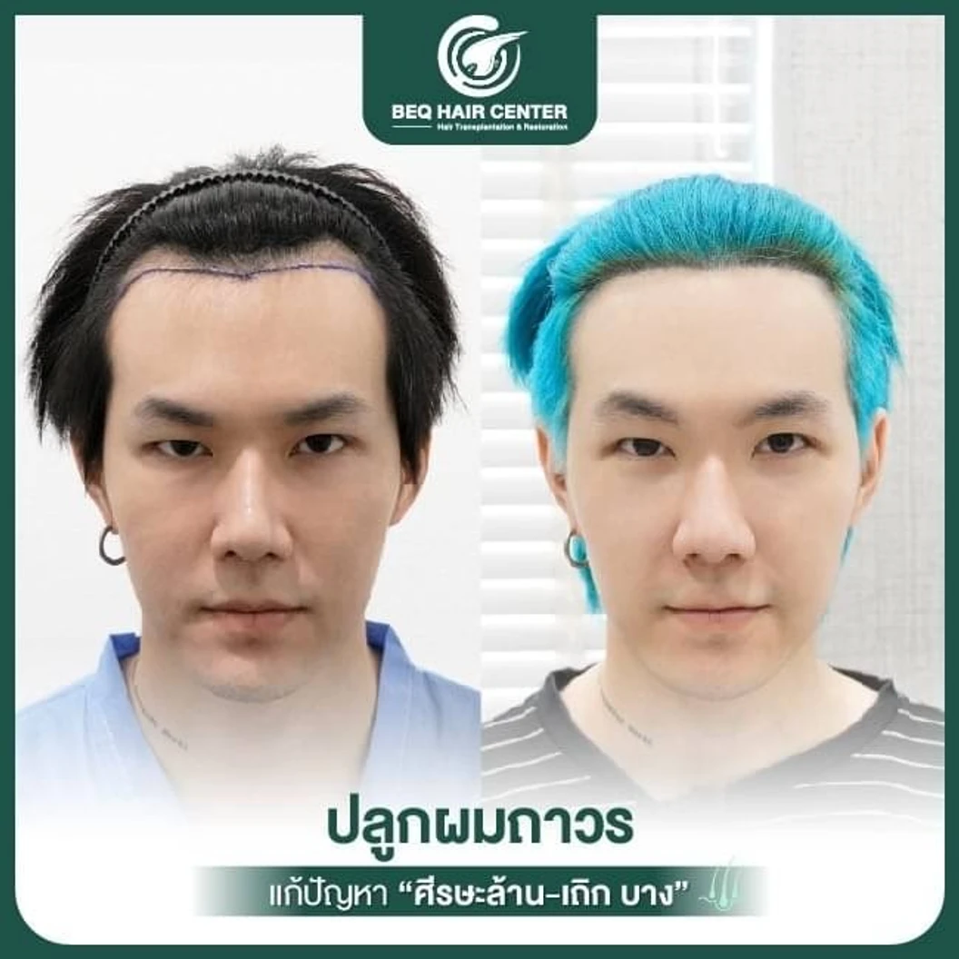 ปลูกผมเทคนิค iDHI แบบโกนผม สูงสุด 1,000 กราฟต์