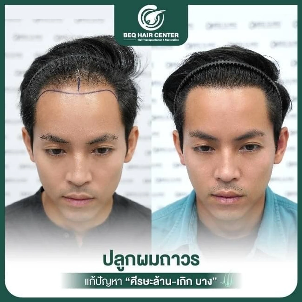 ปลูกผมเทคนิค Non Shaven แบบไม่โกนผม สูงสุด 1,000 กราฟต์