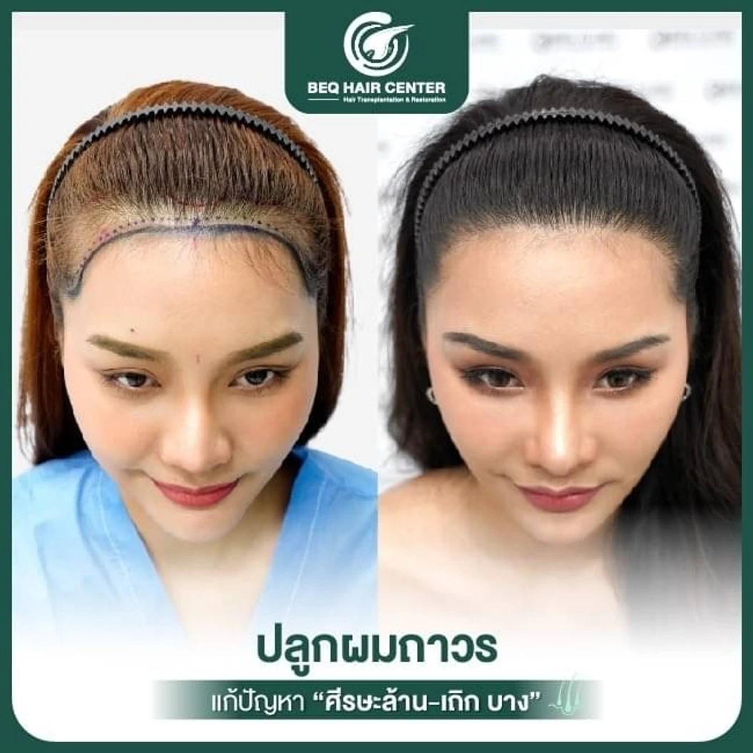 ปลูกผมเทคนิค Non Shaven แบบไม่โกนผม สูงสุด 1,000 กราฟต์