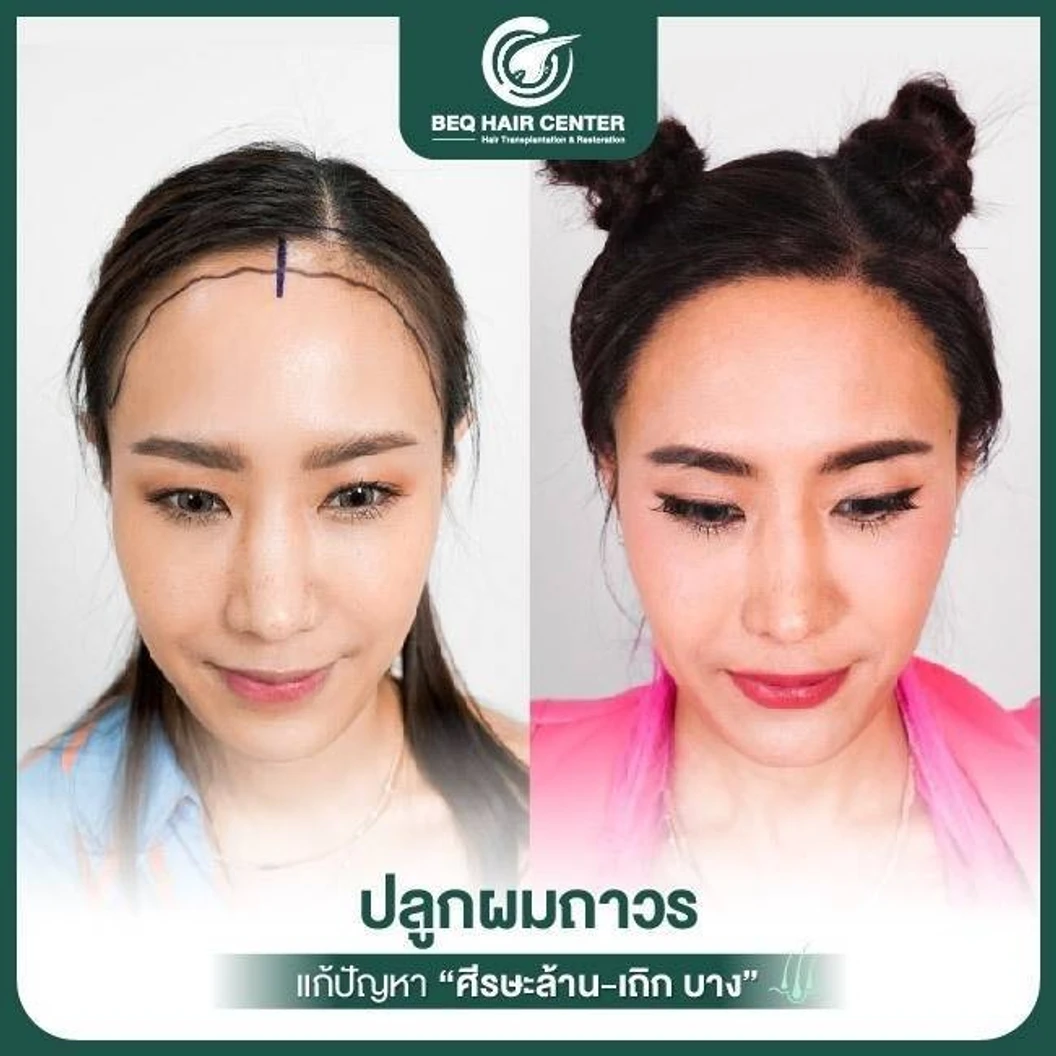 ปลูกผมเทคนิค Non Shaven แบบไม่โกนผม สูงสุด 1,000 กราฟต์