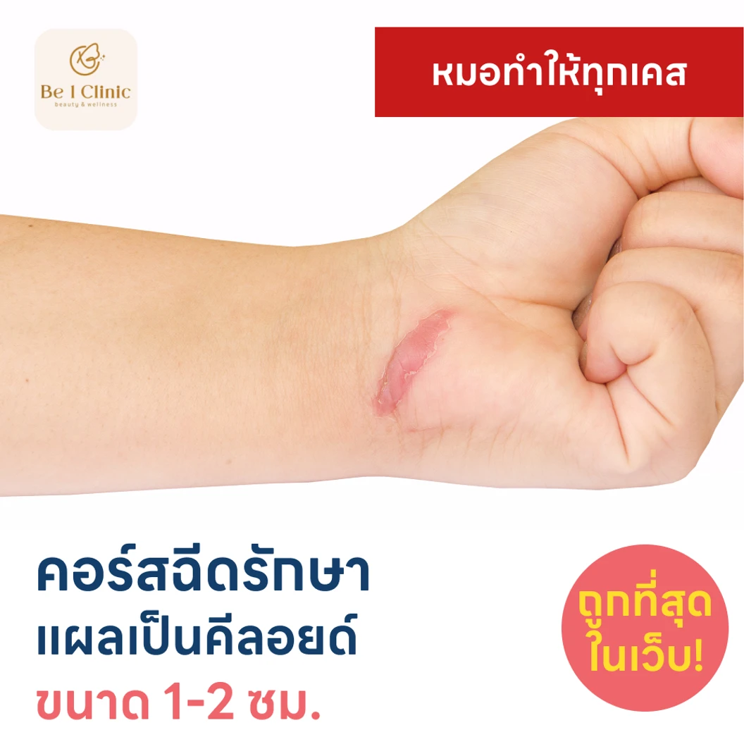 คอร์สฉีดรักษาแผลเป็นคีลอยด์ ขนาดเส้นผ่านศูนย์กลาง 1-2 ซม. 1 จุด 5 ครั้ง