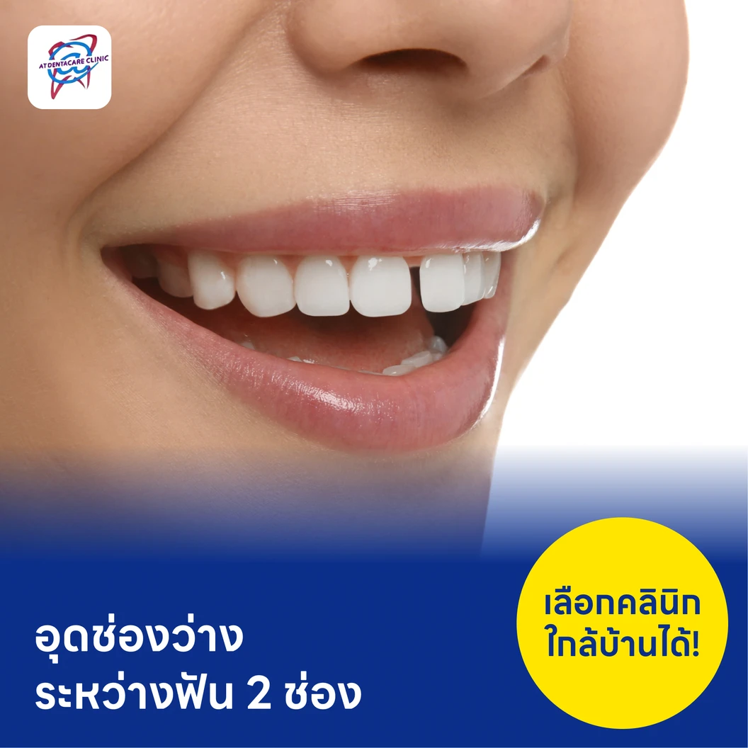 อุดช่องว่างระหว่างฟัน 2 ช่อง