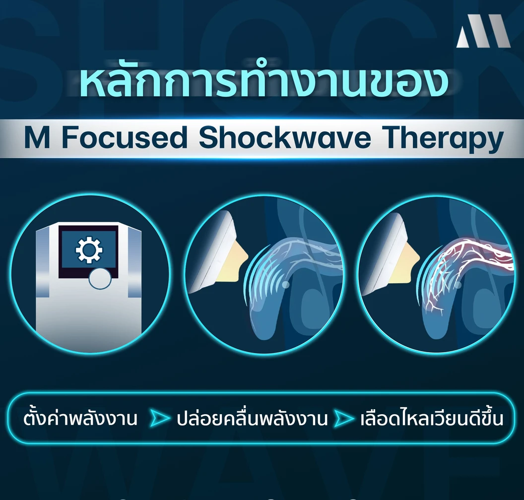 ทำ Shock Wave โปรแกรม M รักษาภาวะหย่อนสมรรถภาพทางเพศ 1 ครั้ง
