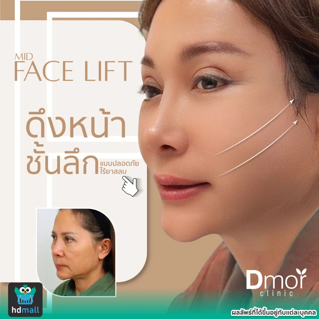 ผ่าตัดดึงหน้า Midface (ครั้งแรก)