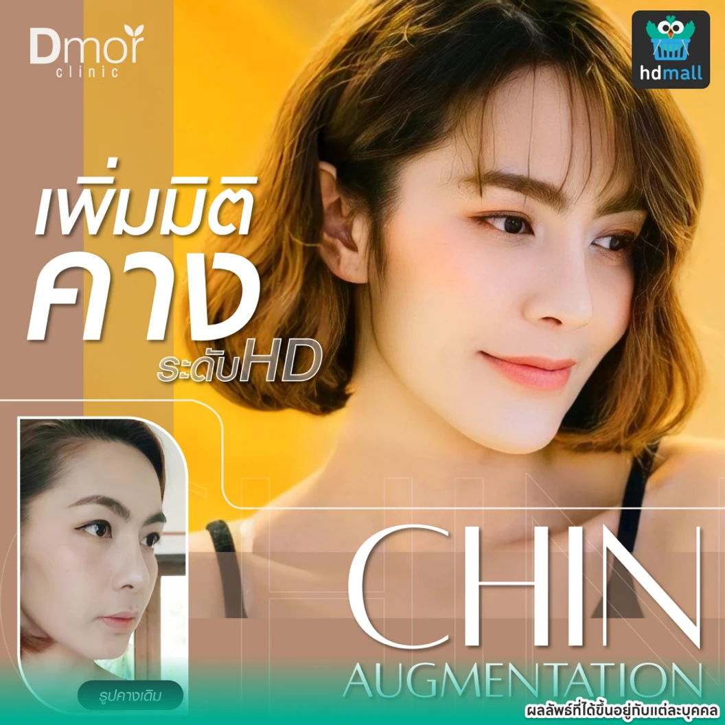 เสริมคางซิลิโคนเกาหลี Implant Grade เทคนิคแผลนอกหรือแผลใน (ครั้งแรก)