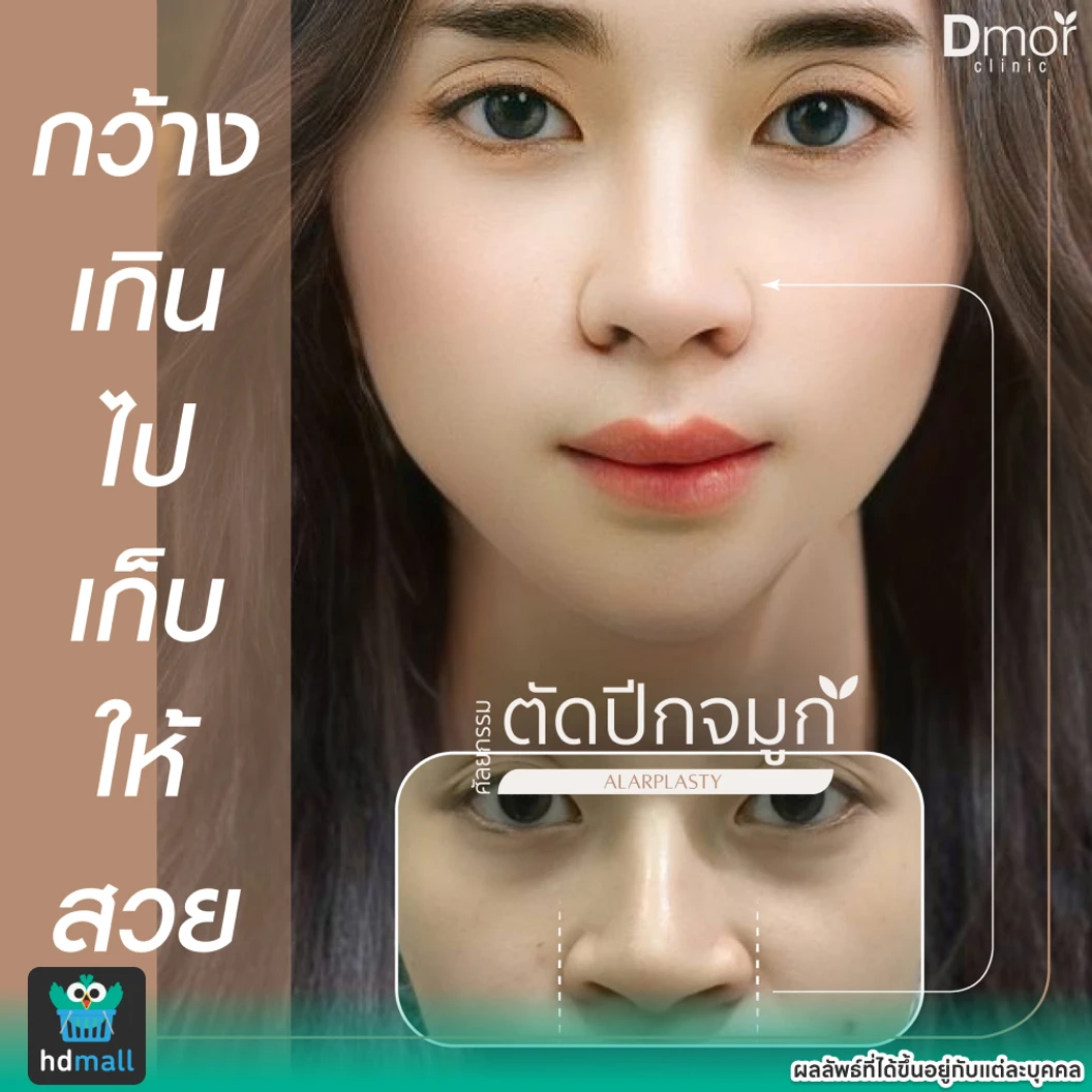 ตัดปีกจมูก เทคนิคซ่อนแผลและเทคนิคแผลนอก (ครั้งแรก)
