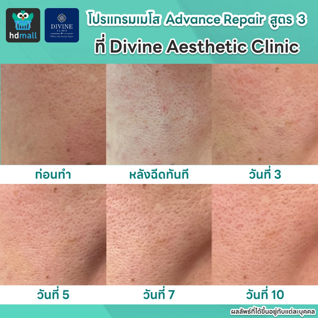 โปรแกรมเมโส Advance Repair สูตร 3 ปริมาณ 5 ซีซี เพื่อปรับผิวหน้าให้ดูเปล่งปลั่ง เรียบเนียน ด้วยเครื่อง Hycoox พร้อม MicroBo USA 10 ยูนิต เพื่อผิวดูเงางาม รูขุมขนดูกระชับ 1 ครั้ง