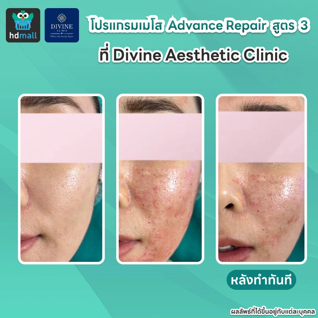 โปรแกรมเมโส Advance Repair สูตร 3 ปริมาณ 5 ซีซี เพื่อปรับผิวหน้าให้ดูเปล่งปลั่ง เรียบเนียน ด้วยเครื่อง Hycoox พร้อม MicroBo USA 10 ยูนิต เพื่อผิวดูเงางาม รูขุมขนดูกระชับ 1 ครั้ง