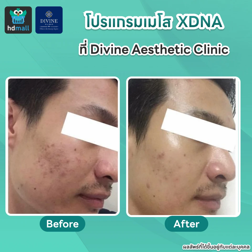 โปรแกรมเมโส XDNA 1 ขวด แก้ปัญหาผิวแห้งมาก แก้ร่องรอยสิว หลุมสิว รูขุมขนกว้าง ผิวหมองคล้ำ ไม่เรียบ 1 ครั้ง