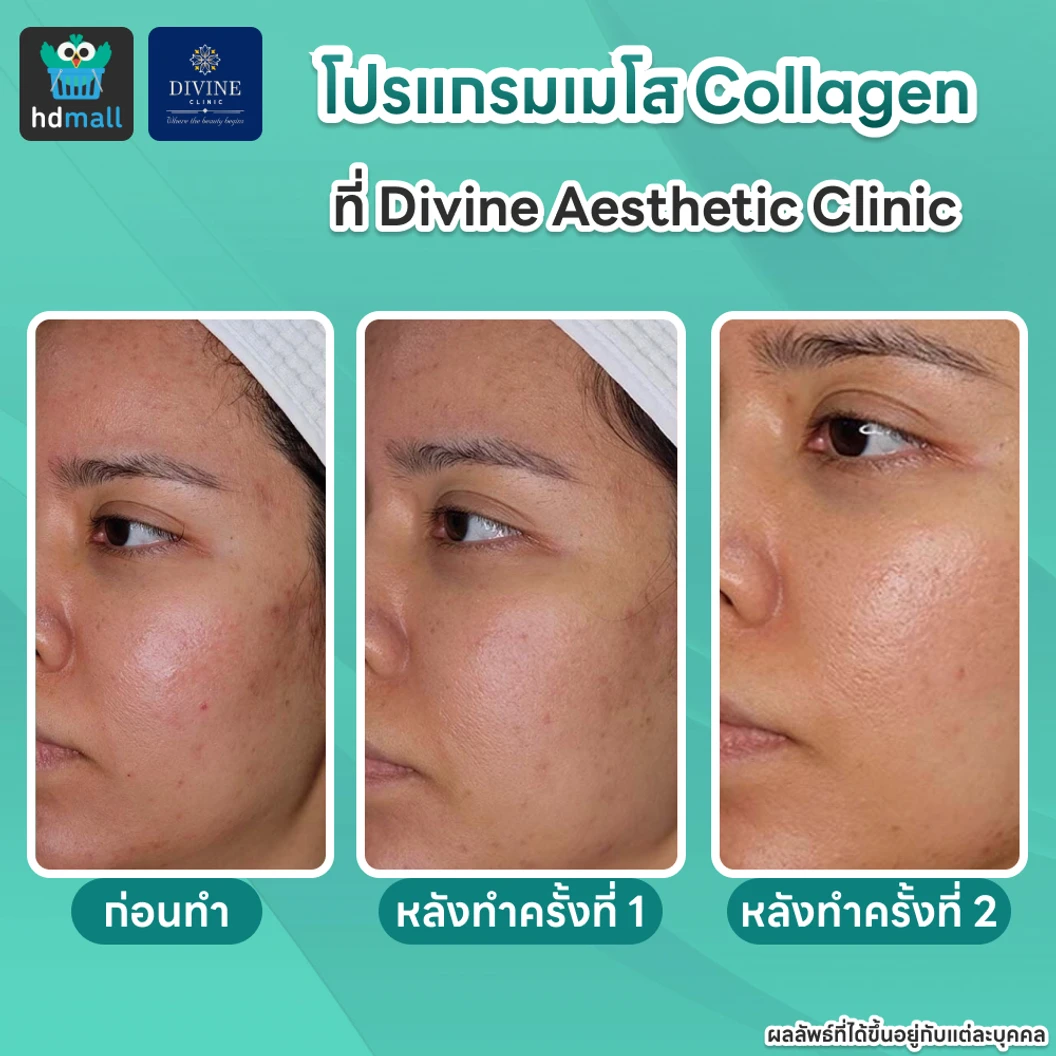 โปรแกรมเมโส Collagen หน้าใสแก้ปัญหาผื่น ผด สิวเรื้อรัง กระตุ้นคอลลาเจน 1 เข็ม