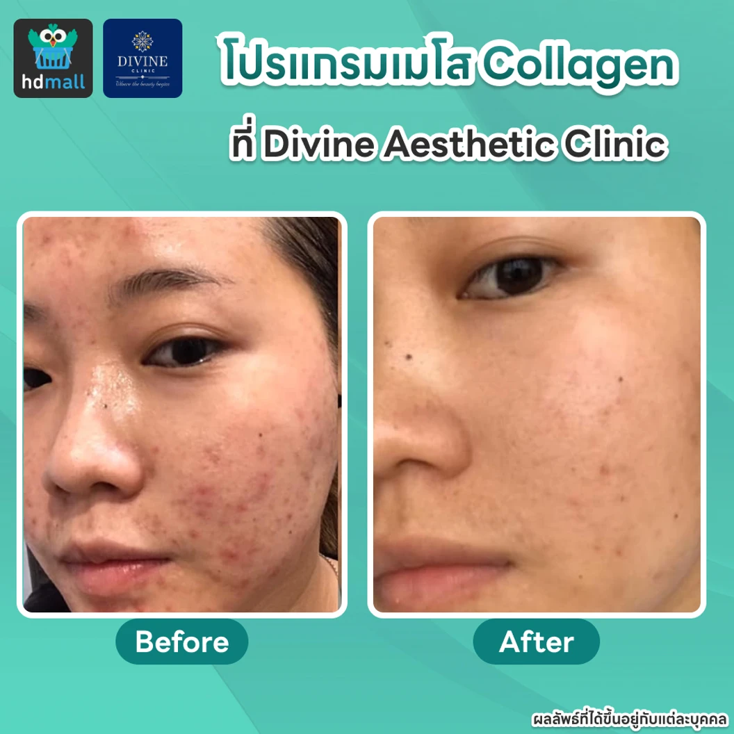 โปรแกรมเมโส Collagen หน้าใสแก้ปัญหาผื่น ผด สิวเรื้อรัง กระตุ้นคอลลาเจน 1 เข็ม