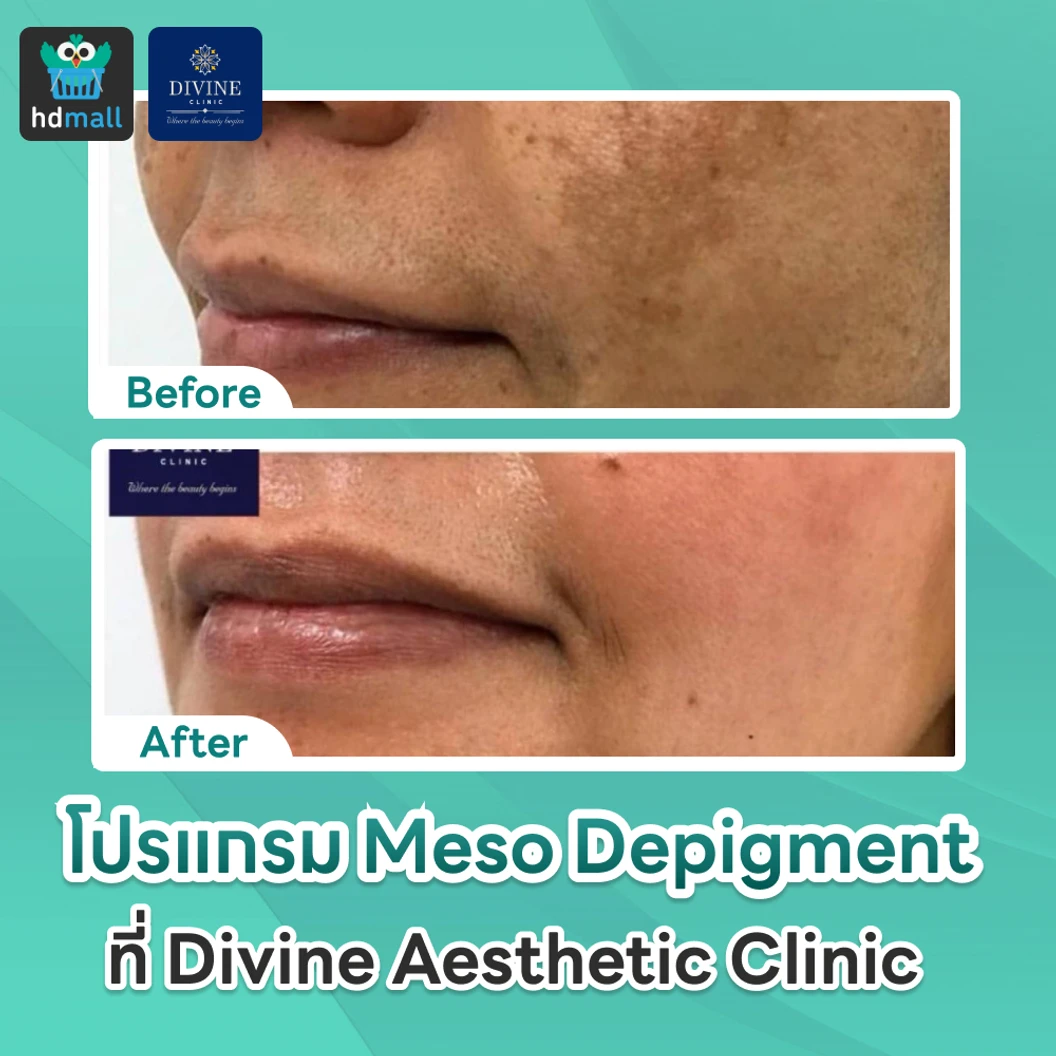 โปรแกรม Meso Depigment 1 ขวด 3 มล. ลดฝ้า กระ เม็ดสีเข้ม ปรับผิวกระจ่างใส 1 ครั้ง