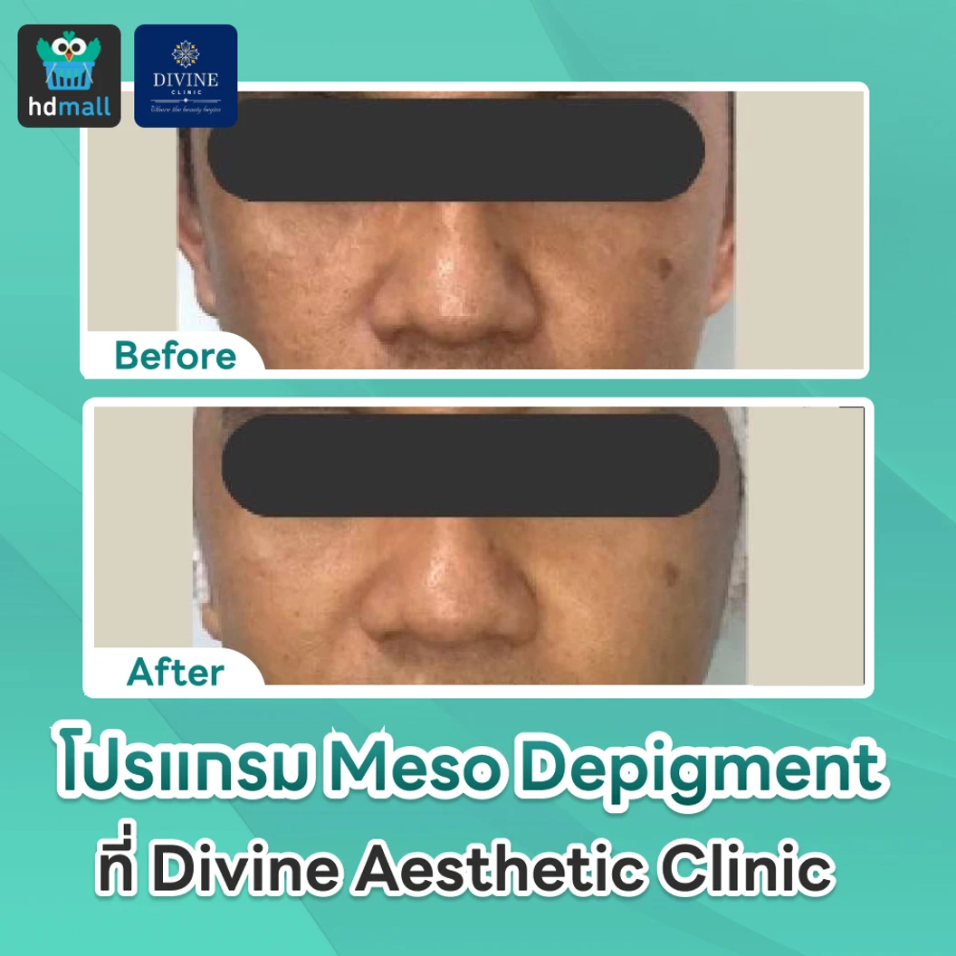 โปรแกรม Meso Depigment 1 ขวด 3 มล. ลดฝ้า กระ เม็ดสีเข้ม ปรับผิวกระจ่างใส 1 ครั้ง