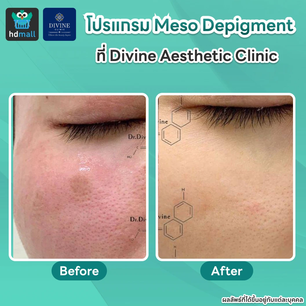 โปรแกรม Meso Depigment 1 ขวด 3 มล. ลดฝ้า กระ เม็ดสีเข้ม ปรับผิวกระจ่างใส 1 ครั้ง