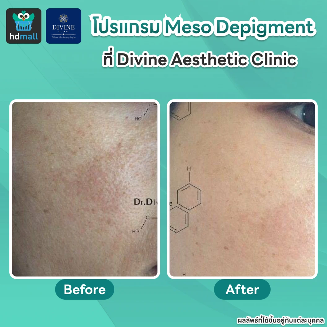 โปรแกรม Meso Depigment 1 ขวด 3 มล. ลดฝ้า กระ เม็ดสีเข้ม ปรับผิวกระจ่างใส 1 ครั้ง