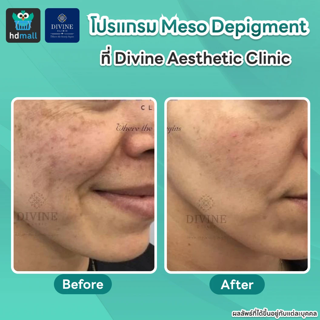 โปรแกรม Meso Depigment 1 ขวด 3 มล. ลดฝ้า กระ เม็ดสีเข้ม ปรับผิวกระจ่างใส 1 ครั้ง