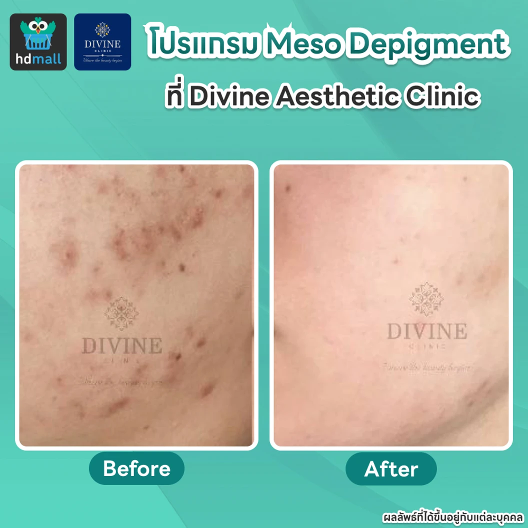 โปรแกรม Meso Depigment 1 ขวด 3 มล. ลดฝ้า กระ เม็ดสีเข้ม ปรับผิวกระจ่างใส 1 ครั้ง