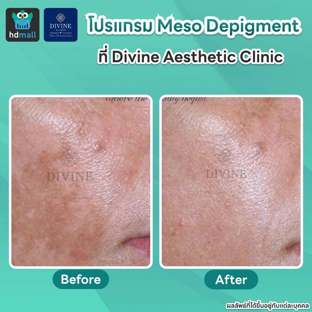 โปรแกรม Meso Depigment 1 ขวด 3 มล. ลดฝ้า กระ เม็ดสีเข้ม ปรับผิวกระจ่างใส 1 ครั้ง