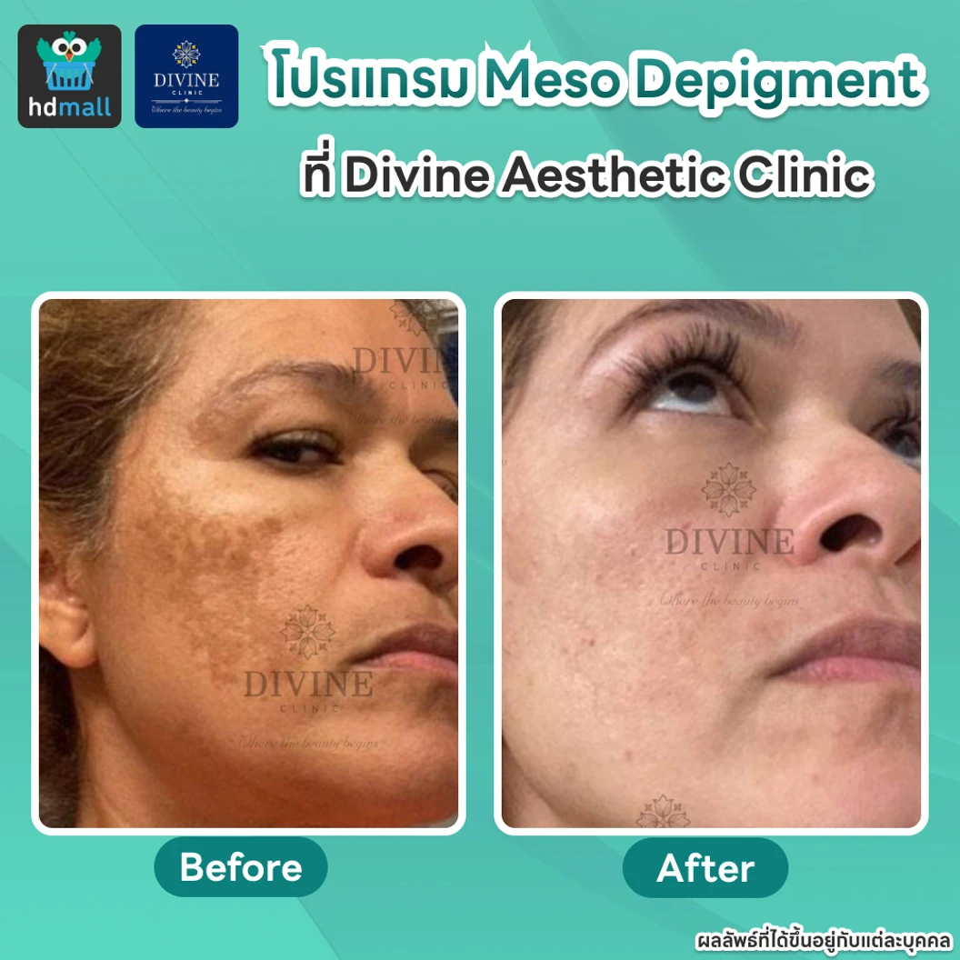 โปรแกรม Meso Depigment 1 ขวด 3 มล. ลดฝ้า กระ เม็ดสีเข้ม ปรับผิวกระจ่างใส 1 ครั้ง